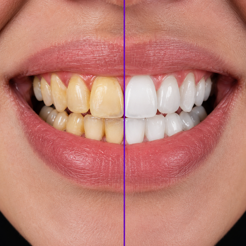 Pétille Strips — Whiter Teeth in 30 Minutes